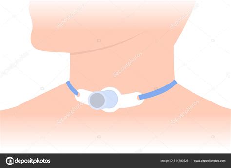 Tracheostomy Tube Patient Neck Who Can Breathe Nose Mouth Illustration
