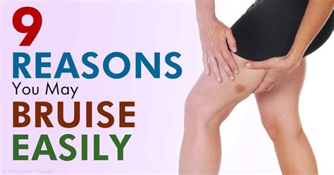9 Reasons Why You May Bruise Easily Ramsey Nj Patch