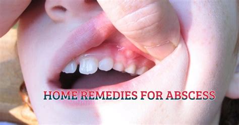 Kid With Abscess On Gum Tooth Abscess Treatment Home Remedy Review