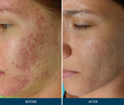 Skin Pen Before And After 2 Debra Tanner Abell Md