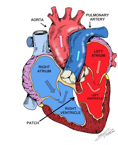 Ventricular Septal Defect The Patient Guide To Heart Lung And