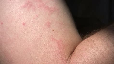 Stock Video Of Skin Allergy Hand Rash 2470751 Shutterstock