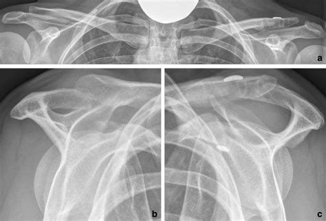 Bilateral Anteroposterior A And Horizontal Stress Views B C