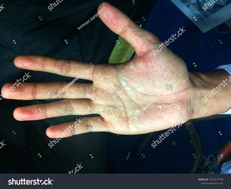 Hand Skin Peeling Due Allergic Reaction Stock Photo Edit Now 1027917739