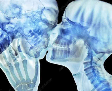 Lovers Kissing X Ray Stock Image C014 4688 Science Photo Library