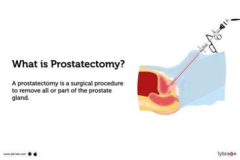 Prostatectomy Purpose Procedure Benefits And Side Effects