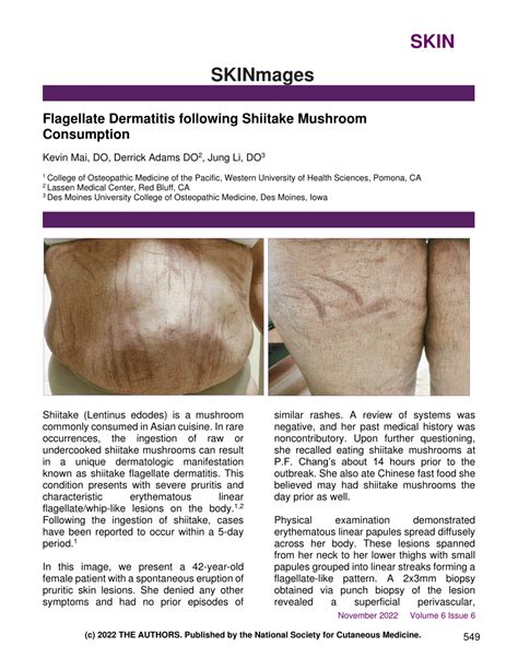 Pdf Flagellate Dermatitis Following Shiitake Mushroom Consumption