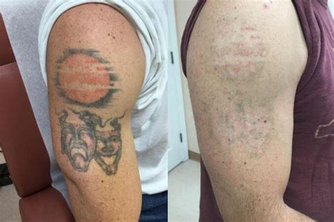How Effective Is Laser Tattoo Removal For Colors Guilford Laser