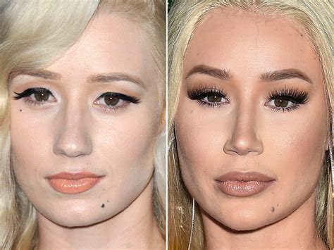 iggy azalea plastic surgery before and after