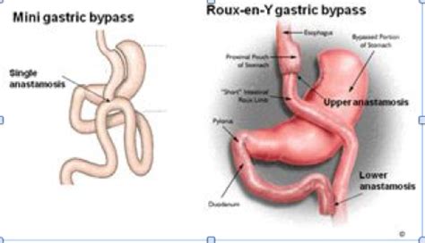 Omega Loop Gastric Bypass Mini Lap Surgery Brisbane