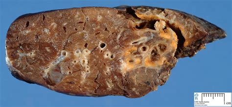 See how the lungs work normally and how cystic fibrosis can affect the lungs over time. bronchiectasis - Humpath.com - Human pathology