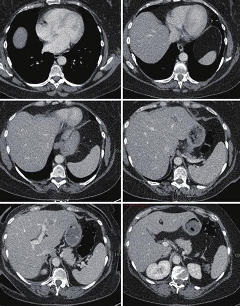 Preoperative Triple Phase Ct Liver In Patient 1 Download Scientific