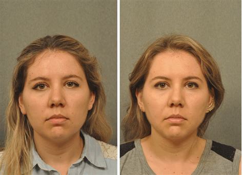 Chubby cheeks nursery rhyme lyrics: Pin on Changes : Before and After Plastic Surgery