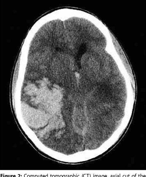 Figure 2 From Fatal Intracranial Hemorrhage As The Initial Presentation