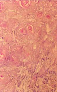 Photomicrograph Showing Invasive Squamous Cell Carcinoma Of The Scalp