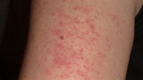 Stress Rash How To Identify And Treat Rashes Caused By Stress