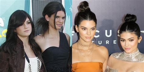 Has Kendall Jenner Had Plastic Surgery Face Before And After