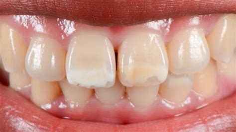 Preoperative Look White Spot On Tooth 11 And 21 And Central Diastema