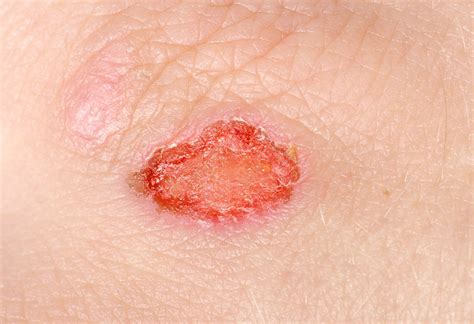 Wound Care Risk Factors And Symptoms