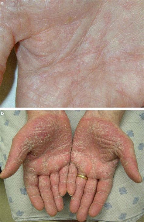 A Chronic Gvhd Presenting As Acral Erythema With Deep Seated Vesicles