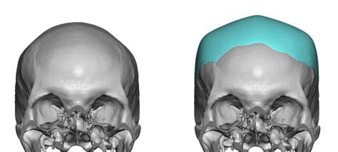 Plastic Surgery Case Study Creating The Model Head Shape With A