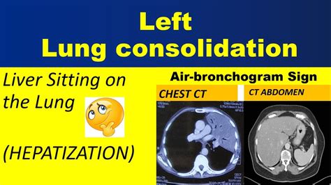 Air Bronchogram Sign Lung Consolidation Hepatization Youtube