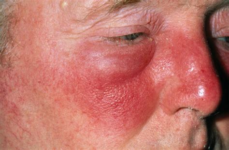 Recurrent Cellulitis Incidence Reduced With Intramuscular Benzathine
