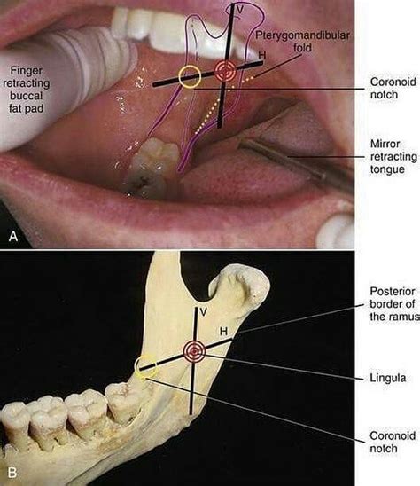 Dental Anatomy For Anesthesia Tag Your Friends Via Howardfarran