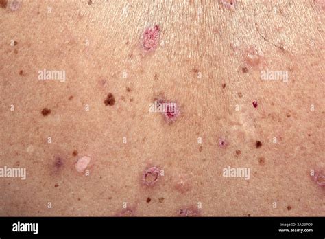 Bullous Pemphigoid Close Up Of Broken Blisters On The Skin Of A 45