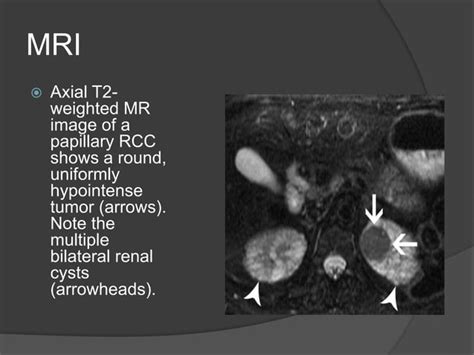 Renal Cell Carcinoma Radiology Ppt