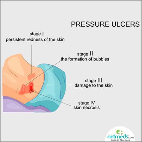 Skin Ulcer Stages