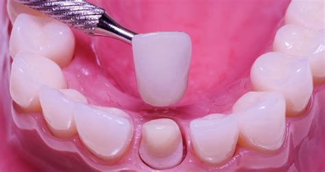 Restorative Dentistry For Tooth Replacement And Dental Repair