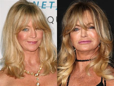Did Goldie Hawn Get Plastic Surgery Face Before And After