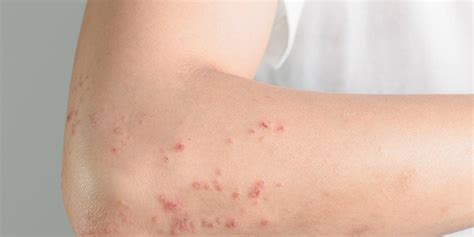 7 Reasons Why You Might Be Breaking Out In Hives Womens Health
