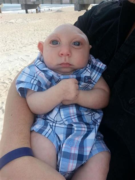 Florida Baby Born Without Most Of His Skull Brain Celebrates 1st