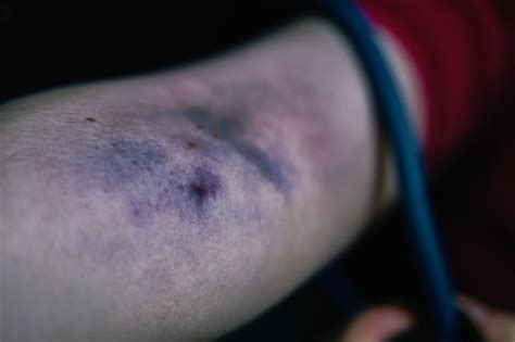 Premium Photo Womans Arm Is Bruised From Taking Intravenous Narcotic