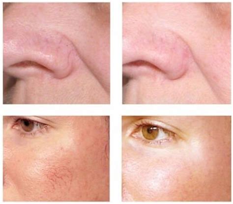 Laser Treatment For Broken Capillaries On Face Before And After