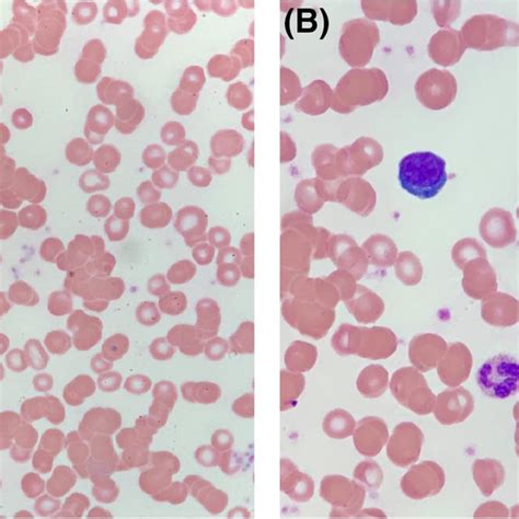 A Lymphoplasmacytoid Cell With Red Cell Agglutination B Reactive