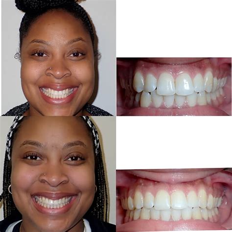 Before And After Braces Wazio Orthodontics