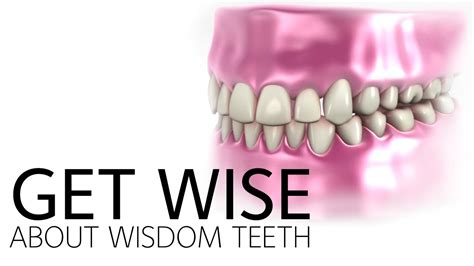 Get Wise About Wisdom Teeth Youtube