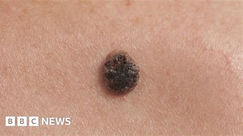 What Is Malignant Melanoma And How Do You Treat It Bbc News