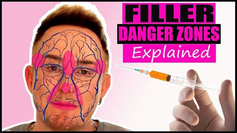 facial filler danger zones visualisation avoid filler gone wrong 2021 youtube