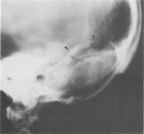 Angiography And Computerized Tomography In The Diagnosis Of Aneurysmal