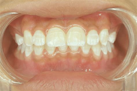 White Spots On Your Gums And Lips
