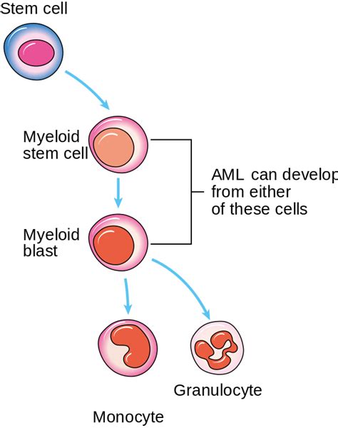 acute myeloid leukemia aml — classification and survival rate