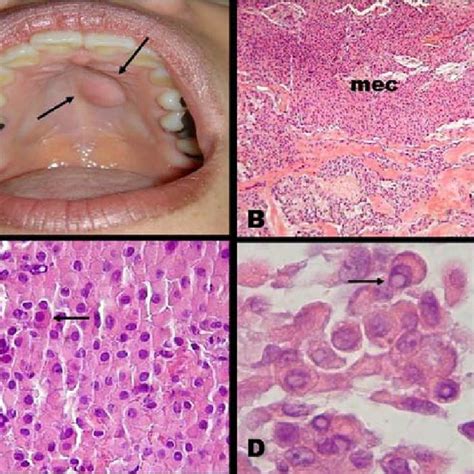 Clinical And Microscopic Aspect Of The Plasmacytoid Myoepithelioma A
