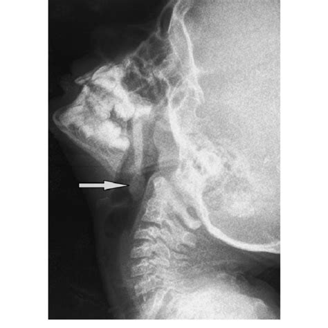 X Ray Of The Soft Tissue Neck Lateral View Showing The Mass Arrow