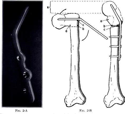 Figure 2 From Treatment Of Coxa Vara In Children By Means Of A Modified