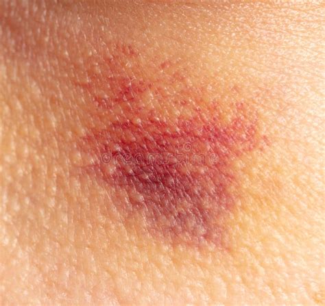 Bruise On Human Skin As A Background Stock Photo Image Of Blood