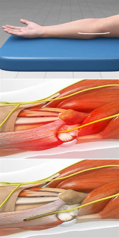 Orthopaedic Trauma Surgeon Elbow Cubital Tunnel Syndr